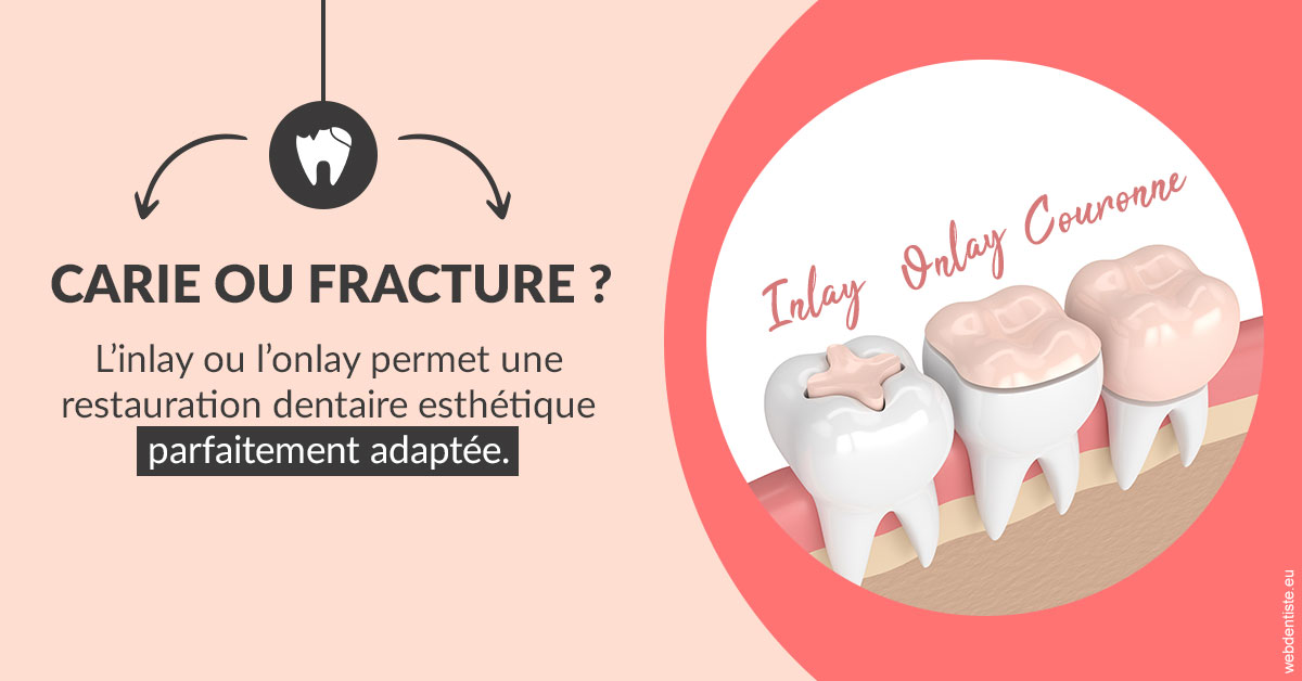 https://dr-levaux-jp.chirurgiens-dentistes.fr/T2 2023 - Carie ou fracture 2