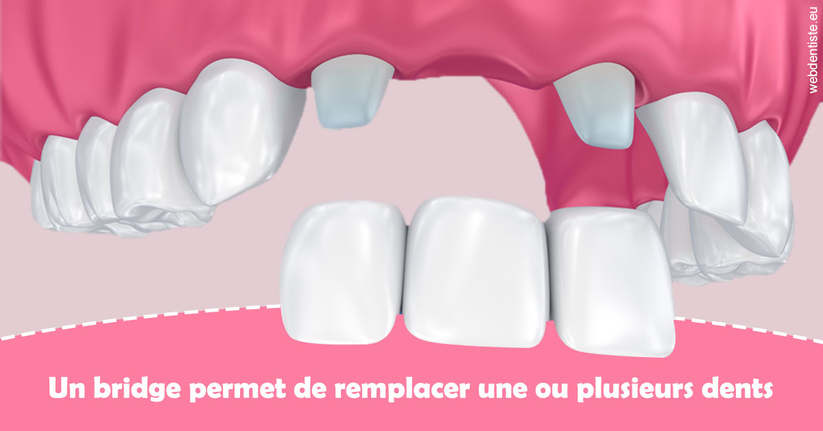 https://dr-levaux-jp.chirurgiens-dentistes.fr/Bridge remplacer dents 2