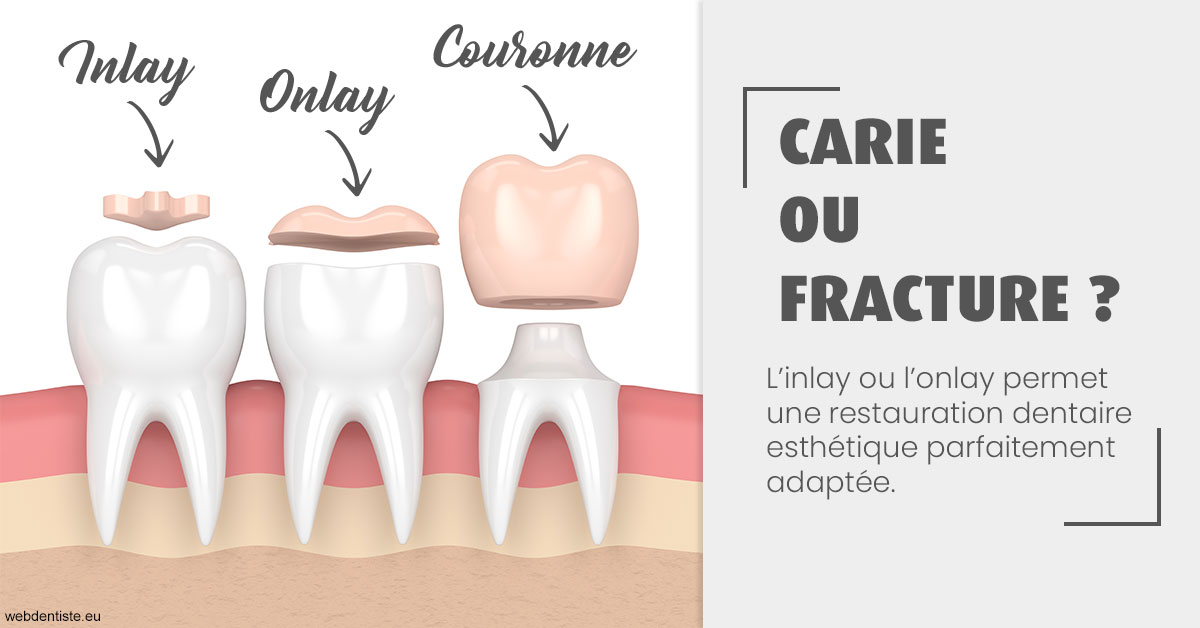 https://dr-levaux-jp.chirurgiens-dentistes.fr/T2 2023 - Carie ou fracture 1