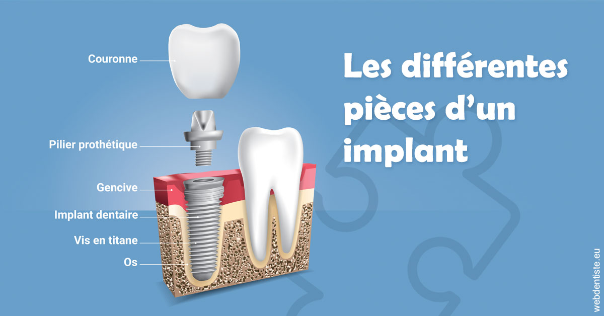 https://dr-levaux-jp.chirurgiens-dentistes.fr/Les différentes pièces d’un implant 1